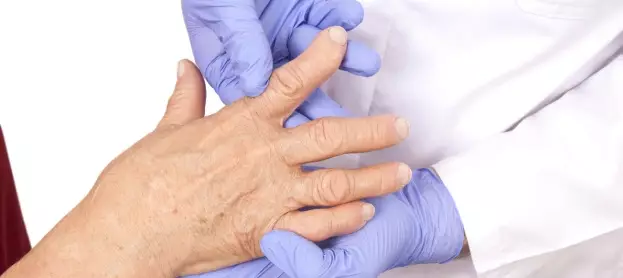 التهاب مفاصل اليد